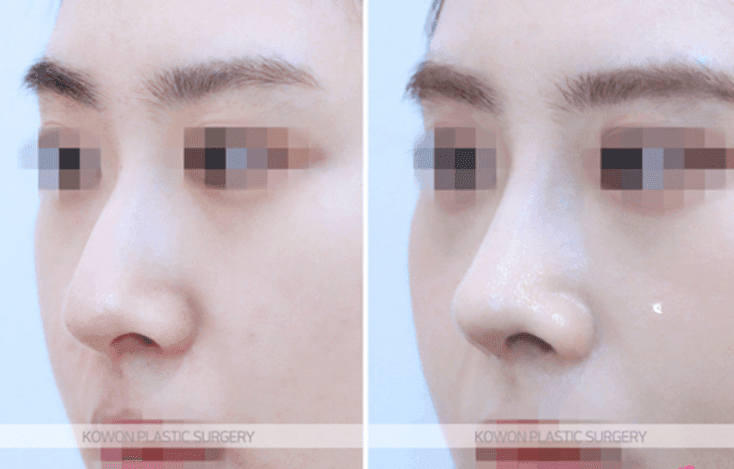 코절골술과 코끝 교정, 복코에는 어느 쪽이 맞을까 — 판단 기준과 실제 사례 관련 이미지 6/9