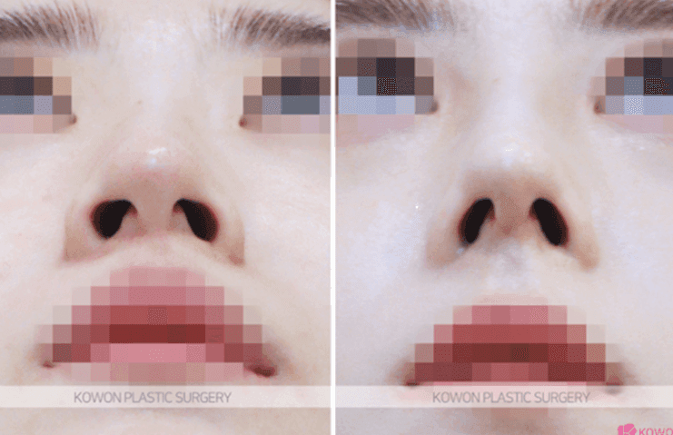 코절골술과 코끝 교정, 복코에는 어느 쪽이 맞을까 — 판단 기준과 실제 사례 관련 이미지 8/9