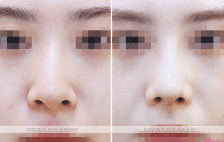 코절골술과 코끝 교정, 복코에는 어느 쪽이 맞을까 — 판단 기준과 실제 사례 관련 이미지 9/9