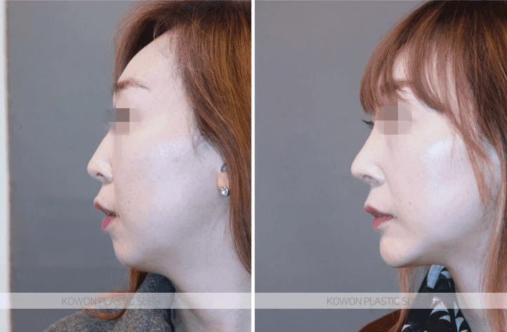 ฉันใส่อิมแพลนต์หน้าอกขนาด 4 มม. แต่ไม่รู้สึกถึงผลใดๆ — ทำไมความสูงถึงไม่เป็นไปตามที่คาดหวัง ภาพที่เกี่ยวข้อง 4/5