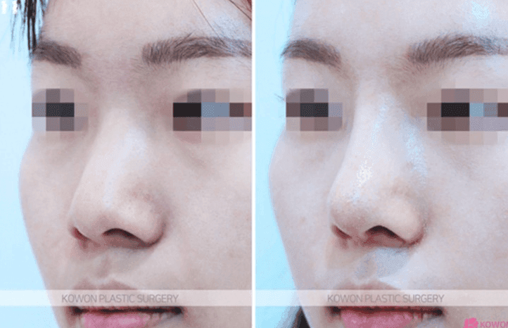 ฉันใส่อิมแพลนต์หน้าอกขนาด 4 มม. แต่ไม่รู้สึกถึงผลใดๆ — ทำไมความสูงถึงไม่เป็นไปตามที่คาดหวัง ภาพที่เกี่ยวข้อง 5/5