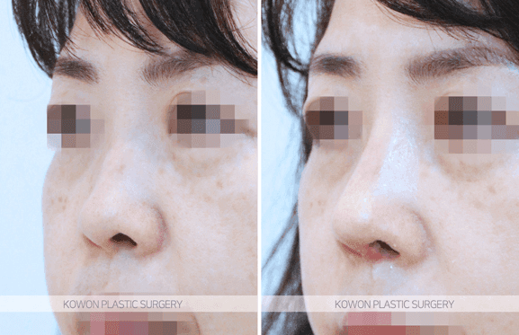 귀족수술 보형물 후 붓기·통증·윗입술 감각 저하, 기다려도 될까 — 지켜볼 증상과 바로 확인할 증상 관련 이미지 3/5