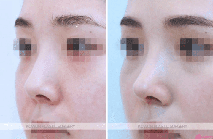 귀족수술 보형물 후 붓기·통증·윗입술 감각 저하, 기다려도 될까 — 지켜볼 증상과 바로 확인할 증상 관련 이미지 4/5