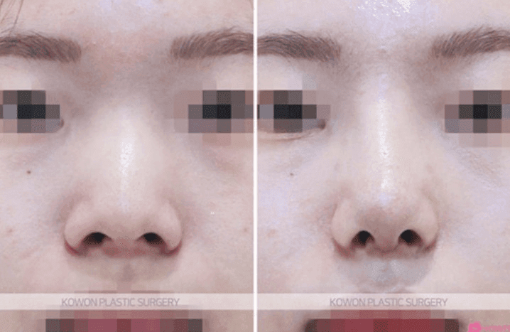 귀족수술 보형물 후 붓기·통증·윗입술 감각 저하, 기다려도 될까 — 지켜볼 증상과 바로 확인할 증상 관련 이미지 5/5