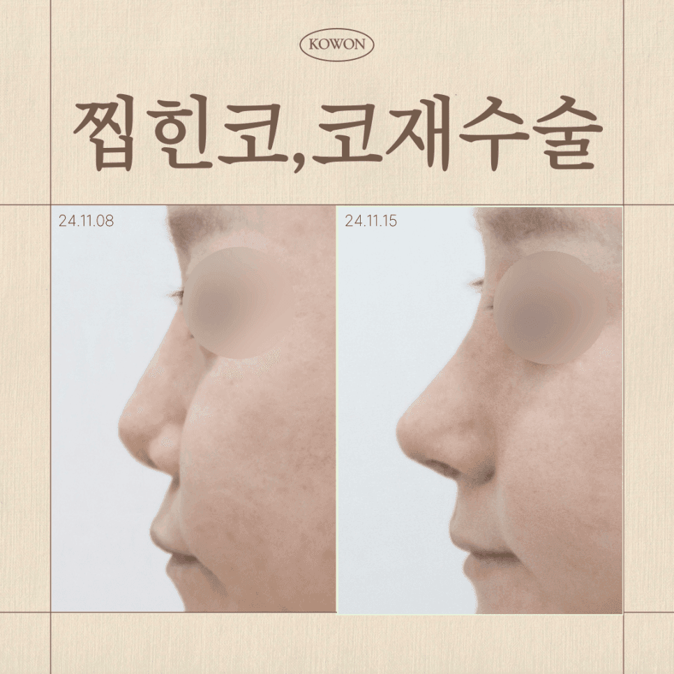 찝힌코, 코재수술이 필요한 상태일까 — 구조 점검이 필요한 다섯 가지 신호 관련 이미지 1/6