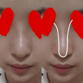 코끝·콧대 수술 두 달 뒤 화살코처럼 보인다면 — 수술 전 사진부터 확인하는 이유 관련 이미지 3/6
