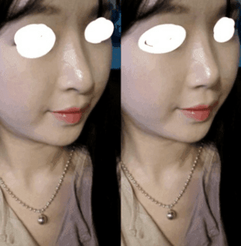 코끝·콧대 수술 두 달 뒤 화살코처럼 보인다면 — 수술 전 사진부터 확인하는 이유 관련 이미지 4/6