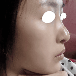 코끝·콧대 수술 두 달 뒤 화살코처럼 보인다면 — 수술 전 사진부터 확인하는 이유 관련 이미지 5/6