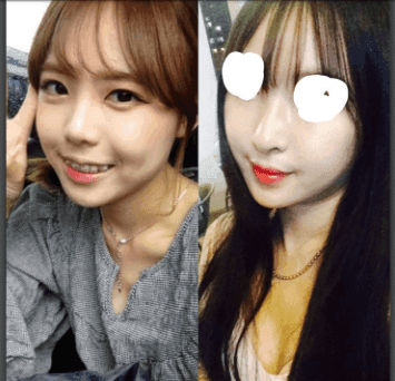 코끝·콧대 수술 두 달 뒤 화살코처럼 보인다면 — 수술 전 사진부터 확인하는 이유 관련 이미지 6/6