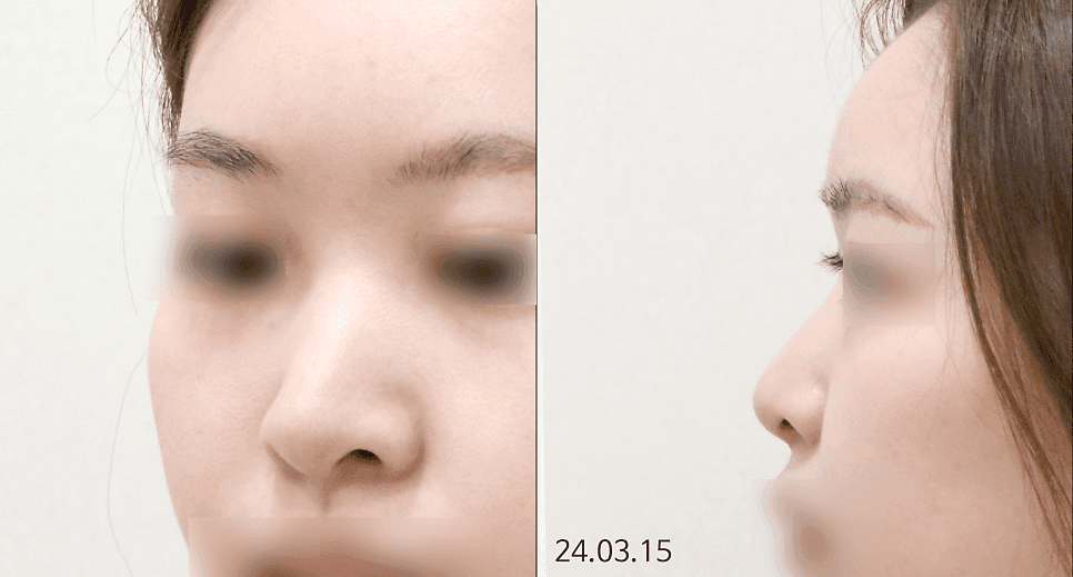 มาตรฐานของจมูกที่สวยงามคืออะไร? — ความกลมกลืนกับใบหน้า และ RIBFIT™ เมื่ออิมแพลนต์เป็นภาระ ภาพประกอบที่เกี่ยวข้องกับ RIBFIT™ 4/12