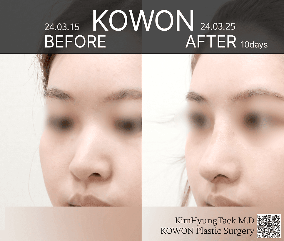 예쁜 코의 기준은 무엇일까 — 얼굴과의 조화, 그리고 보형물이 부담될 때의 RIBFIT™ 리브핏 관련 이미지 5/12