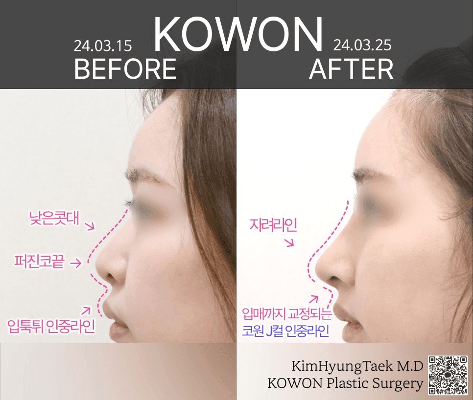 มาตรฐานของจมูกที่สวยงามคืออะไร? — ความกลมกลืนกับใบหน้า และ RIBFIT™ เมื่ออิมแพลนต์เป็นภาระ RIBFIT™ภาพที่เกี่ยวข้อง 12/12