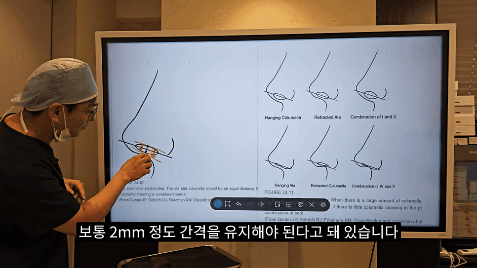돌출입코성형과 ACR — 비주와 콧날개의 관계가 비순각·비주내리기를 결정하는 이유 관련 이미지 6/31