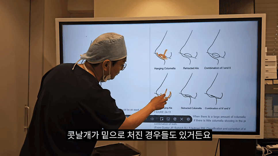 돌출입코성형과 ACR — 비주와 콧날개의 관계가 비순각·비주내리기를 결정하는 이유 관련 이미지 8/31