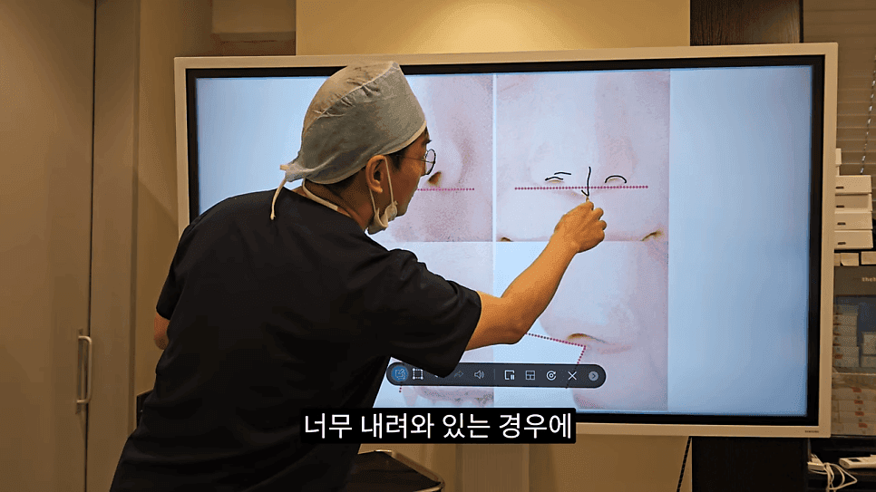 돌출입코성형과 ACR — 비주와 콧날개의 관계가 비순각·비주내리기를 결정하는 이유 관련 이미지 9/31
