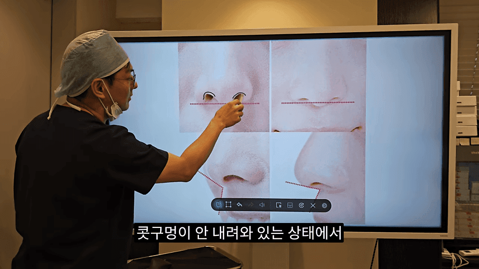돌출입코성형과 ACR — 비주와 콧날개의 관계가 비순각·비주내리기를 결정하는 이유 관련 이미지 10/31