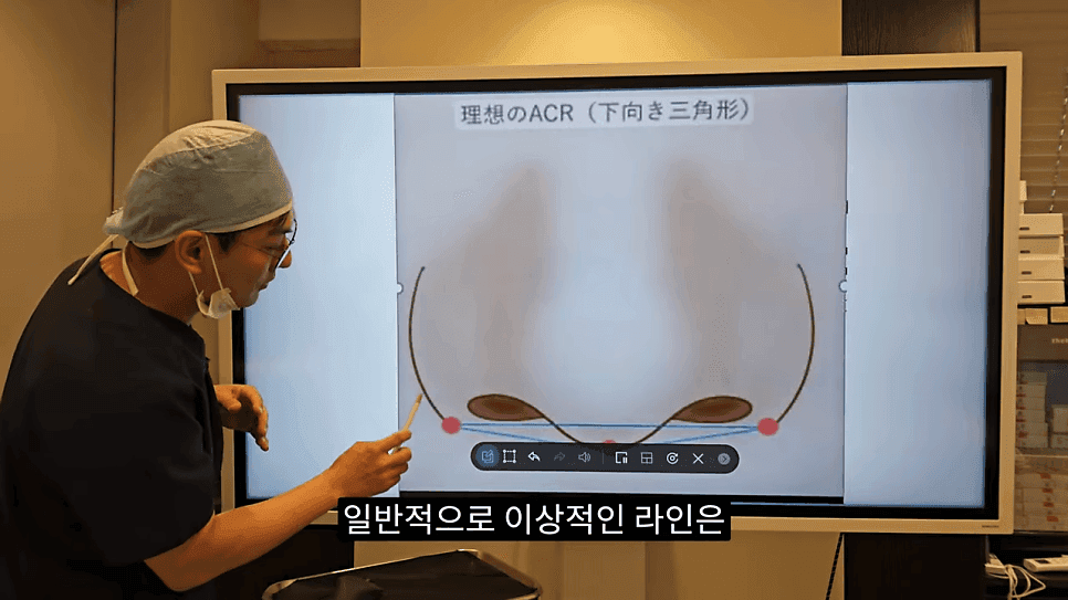 돌출입코성형과 ACR — 비주와 콧날개의 관계가 비순각·비주내리기를 결정하는 이유 관련 이미지 11/31