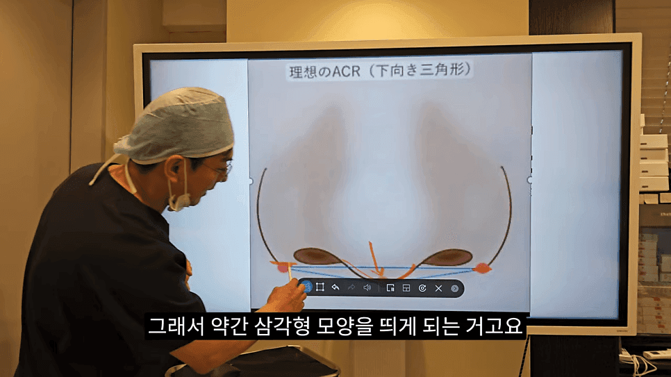 돌출입코성형과 ACR — 비주와 콧날개의 관계가 비순각·비주내리기를 결정하는 이유 관련 이미지 12/31