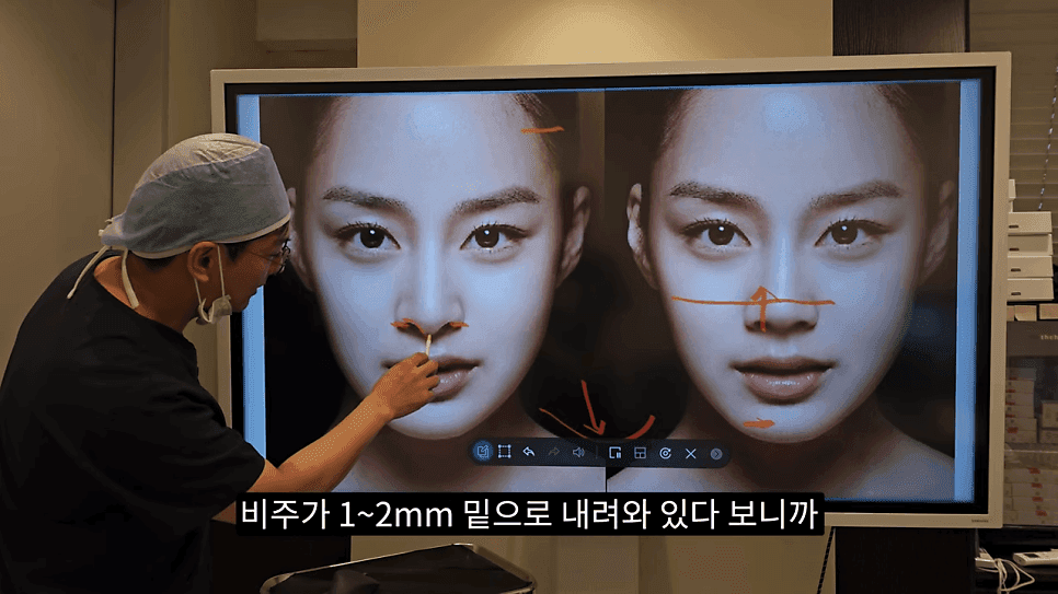 돌출입코성형과 ACR — 비주와 콧날개의 관계가 비순각·비주내리기를 결정하는 이유 관련 이미지 15/31
