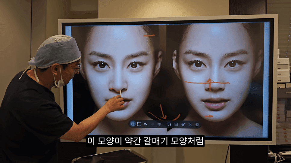 돌출입코성형과 ACR — 비주와 콧날개의 관계가 비순각·비주내리기를 결정하는 이유 관련 이미지 16/31