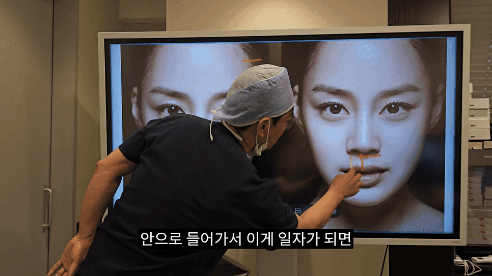 돌출입코성형과 ACR — 비주와 콧날개의 관계가 비순각·비주내리기를 결정하는 이유 관련 이미지 17/31