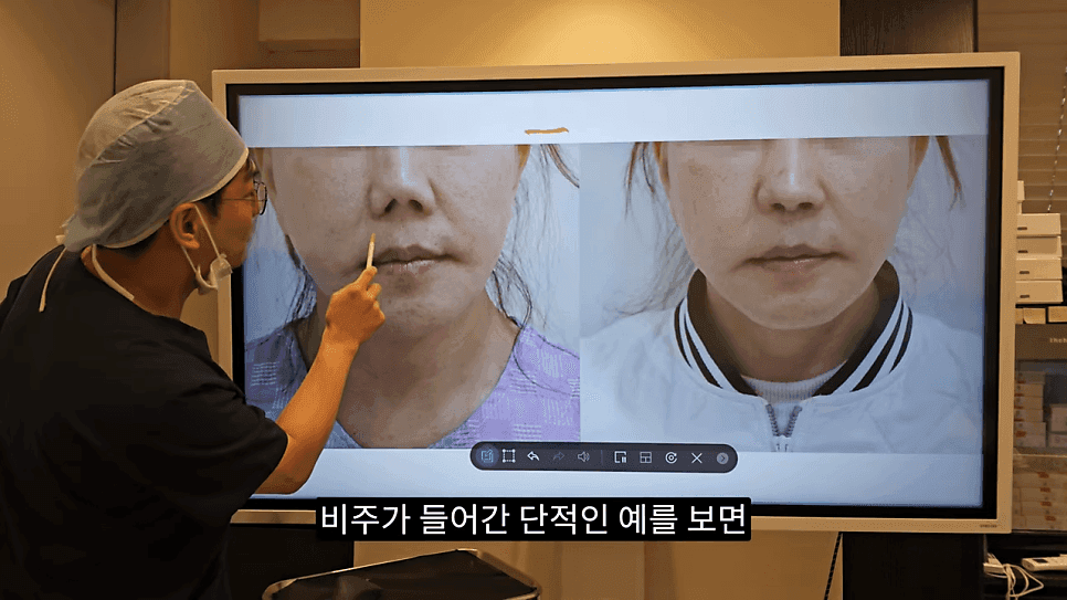 돌출입코성형과 ACR — 비주와 콧날개의 관계가 비순각·비주내리기를 결정하는 이유 관련 이미지 20/31