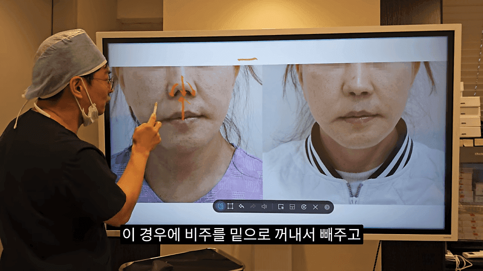돌출입코성형과 ACR — 비주와 콧날개의 관계가 비순각·비주내리기를 결정하는 이유 관련 이미지 21/31