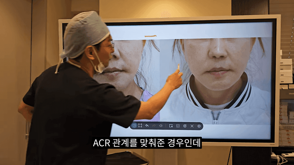 돌출입코성형과 ACR — 비주와 콧날개의 관계가 비순각·비주내리기를 결정하는 이유 관련 이미지 22/31