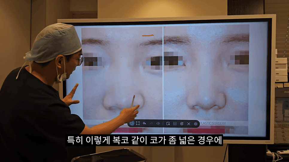 돌출입코성형과 ACR — 비주와 콧날개의 관계가 비순각·비주내리기를 결정하는 이유 관련 이미지 24/31