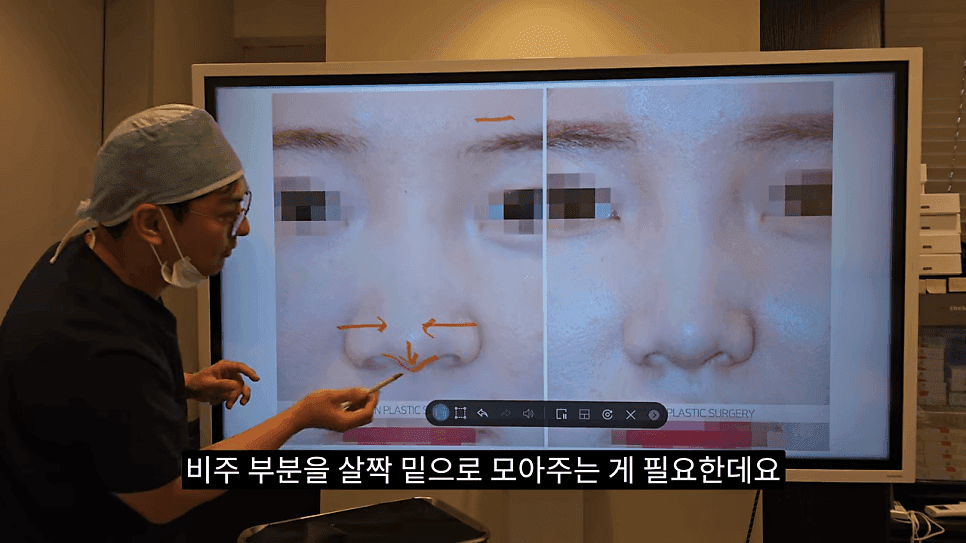 돌출입코성형과 ACR — 비주와 콧날개의 관계가 비순각·비주내리기를 결정하는 이유 관련 이미지 25/31