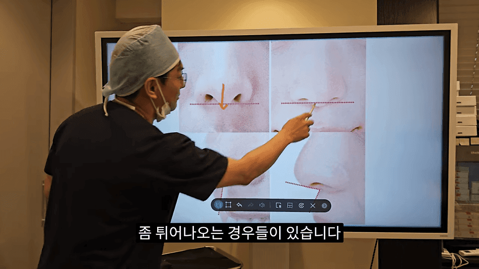 돌출입코성형과 ACR — 비주와 콧날개의 관계가 비순각·비주내리기를 결정하는 이유 관련 이미지 26/31