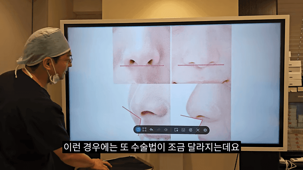돌출입코성형과 ACR — 비주와 콧날개의 관계가 비순각·비주내리기를 결정하는 이유 관련 이미지 27/31