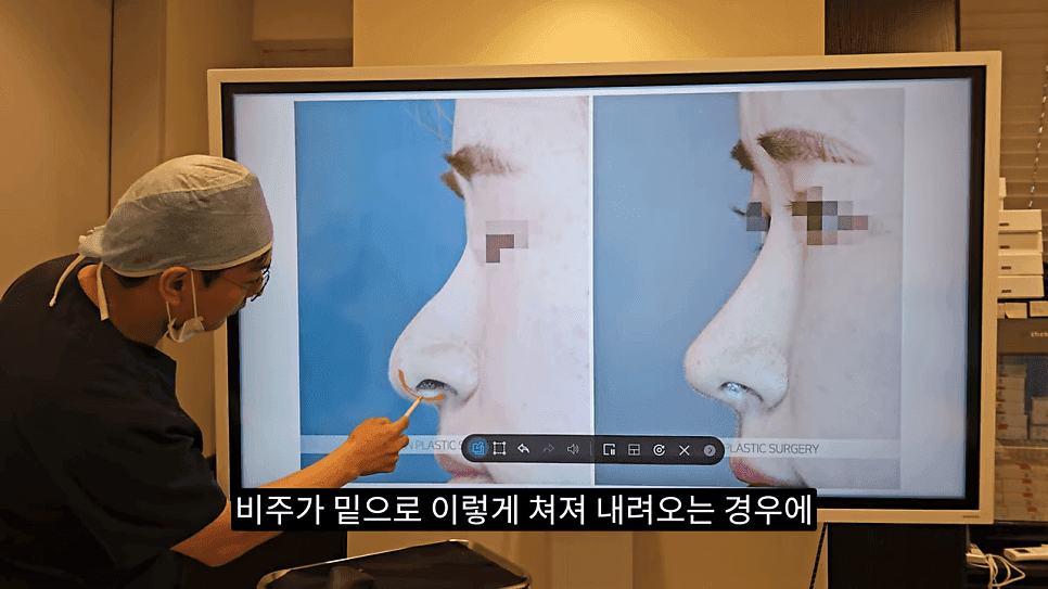 돌출입코성형과 ACR — 비주와 콧날개의 관계가 비순각·비주내리기를 결정하는 이유 관련 이미지 28/31