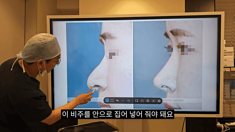 돌출입코성형과 ACR — 비주와 콧날개의 관계가 비순각·비주내리기를 결정하는 이유 관련 이미지 29/31