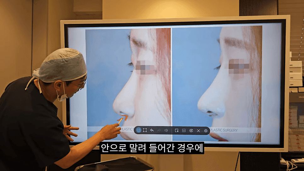돌출입코성형과 ACR — 비주와 콧날개의 관계가 비순각·비주내리기를 결정하는 이유 관련 이미지 30/31