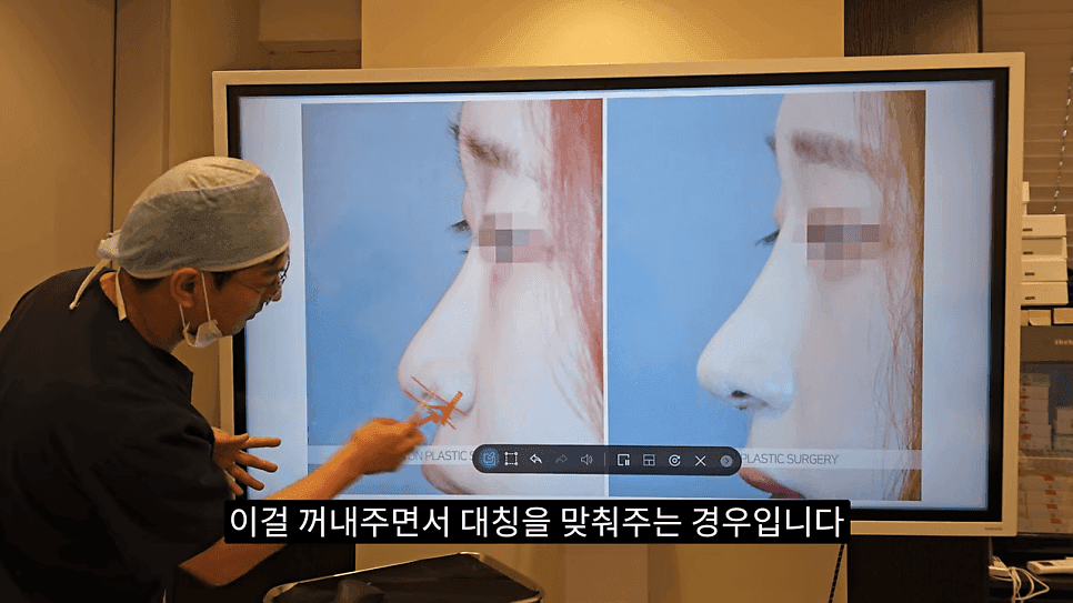 돌출입코성형과 ACR — 비주와 콧날개의 관계가 비순각·비주내리기를 결정하는 이유 관련 이미지 31/31