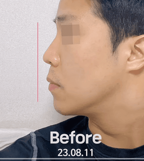돌출입 코수술, 콧볼 축소 없이도 가능할까요? — 비주와 각도로 판단하는 기준 관련 이미지 4/11