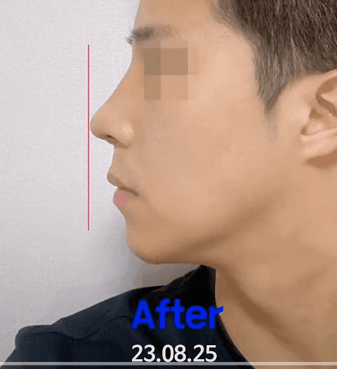 돌출입 코수술, 콧볼 축소 없이도 가능할까요? — 비주와 각도로 판단하는 기준 관련 이미지 6/11