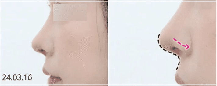 돌출입 코수술, 콧볼 축소 없이도 가능할까요? — 비주와 각도로 판단하는 기준 관련 이미지 8/11