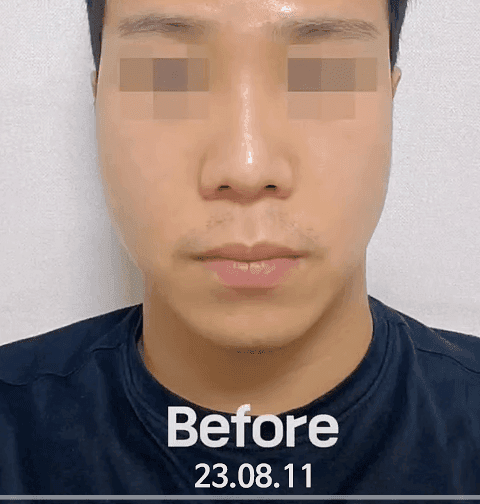돌출입 코수술, 콧볼 축소 없이도 가능할까요? — 비주와 각도로 판단하는 기준 관련 이미지 10/11