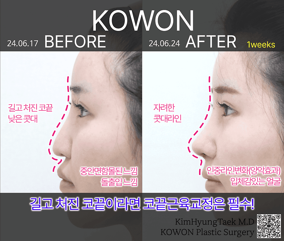 돌출입처럼 보인다면 비순각부터 — 양악·치아 교정 전에 확인하는 코끝 각도 관련 이미지 6/6