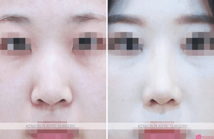 래디어스 필러를 맞은 코, 제거 후 수술이 가능할까요 — 녹지 않는 필러가 있을 때의 확인 순서 관련 이미지 5/5