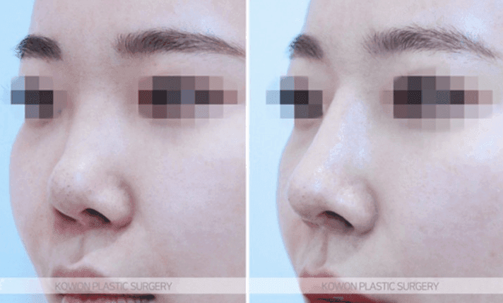 코성형 재수술 시기, 염증을 겪었다면 6개월로 충분할까 — 조직 안정을 기준으로 보는 이유 관련 이미지 4/11