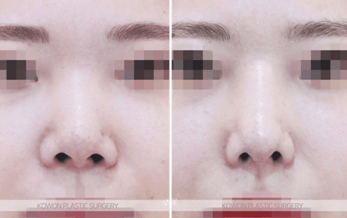 코성형 재수술 시기, 염증을 겪었다면 6개월로 충분할까 — 조직 안정을 기준으로 보는 이유 관련 이미지 7/11
