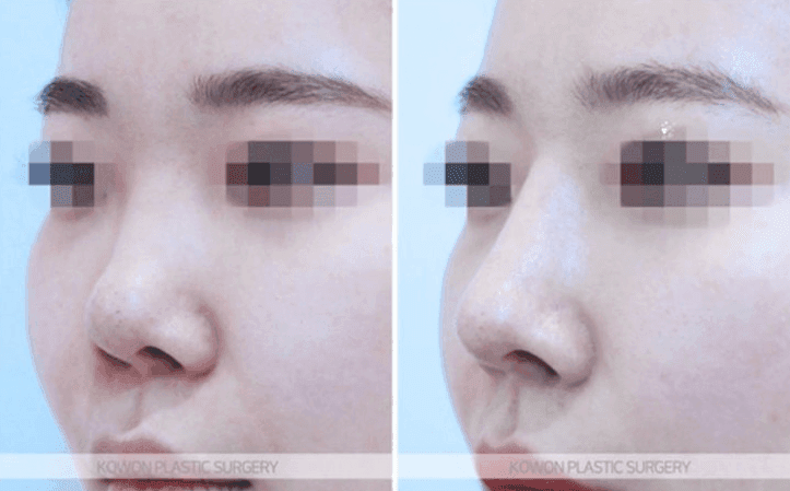 2 เดือนการผ่าตัดจมูกหากคุณรู้สึกว่ากระดูกอ่อนผนังกั้นช่องจมูกยื่นออกมา — เหตุใดจึงแนะนำให้ผ่าตัดแก้ไขหลังจากอย่างน้อย 6 เดือน ภาพที่เกี่ยวข้อง 5/10