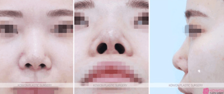 2 เดือนการผ่าตัดจมูกหากคุณรู้สึกว่ากระดูกอ่อนผนังกั้นช่องจมูกยื่นออกมา — เหตุใดจึงแนะนำให้ผ่าตัดแก้ไขหลังจากอย่างน้อย 6 เดือน ภาพประกอบ 6/10