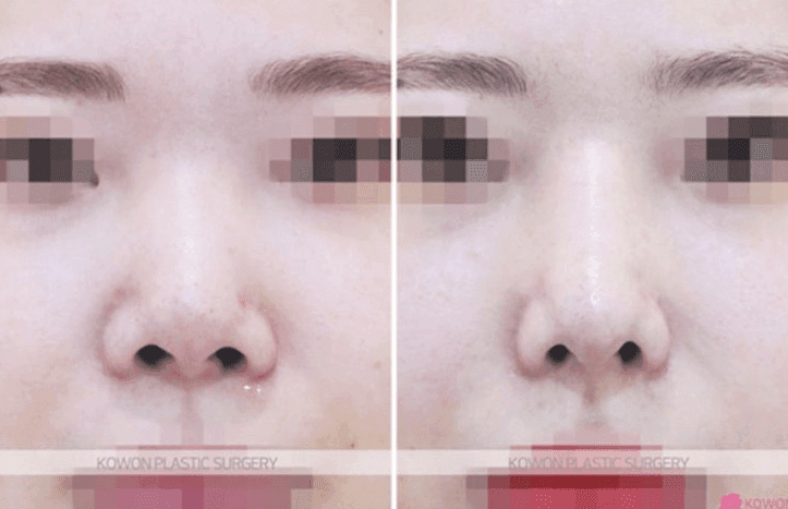 코수술 2개월, 비중격 연골이 튀어나온 느낌이라면 — 재수술 시기를 최소 6개월로 보는 이유 관련 이미지 7/10