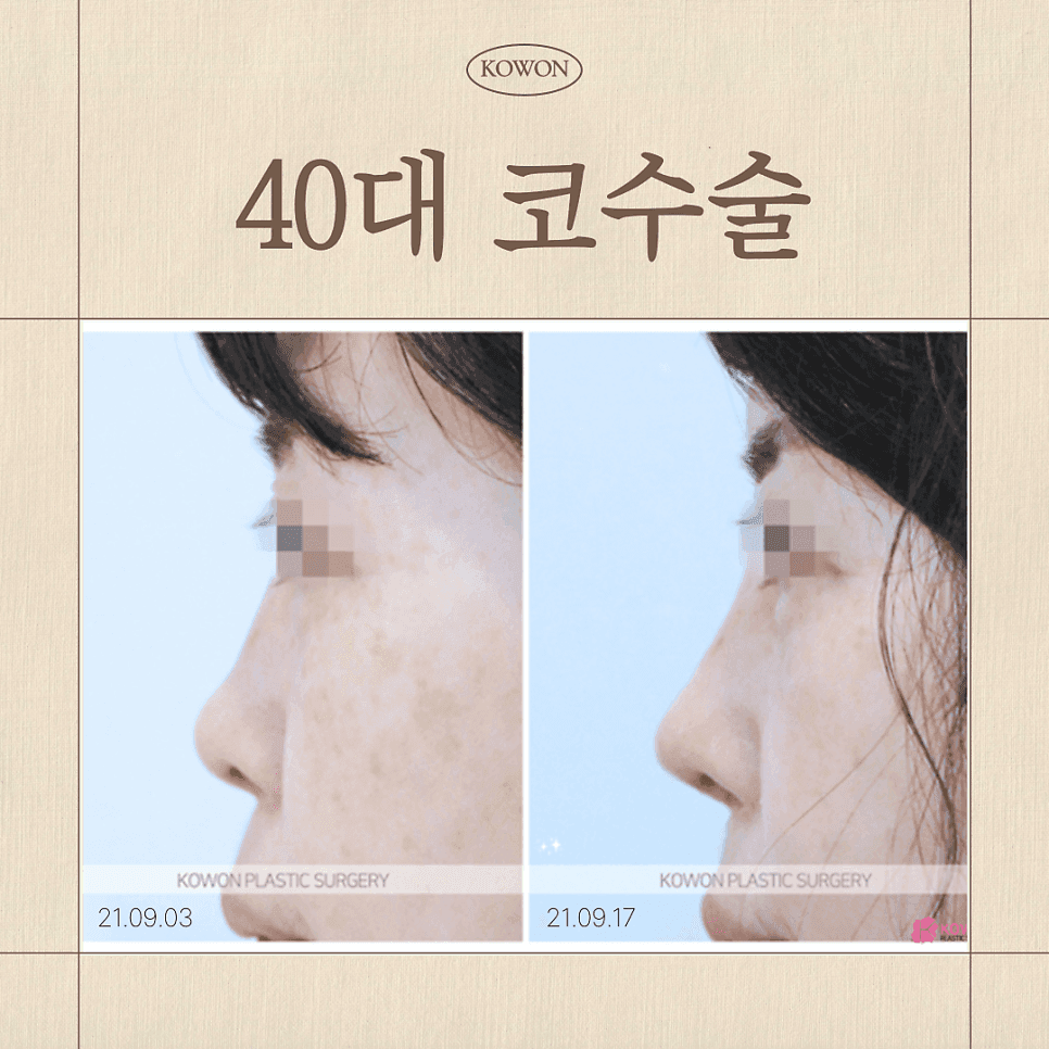 40대 코수술, 회복이 느릴까요? — 자가늑연골과 자가조직보형물이 함께 설명되는 이유 관련 이미지 1/8