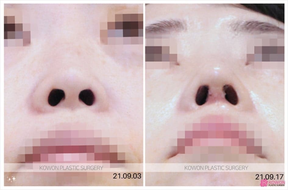 40대 코수술, 회복이 느릴까요? — 자가늑연골과 자가조직보형물이 함께 설명되는 이유 관련 이미지 4/8