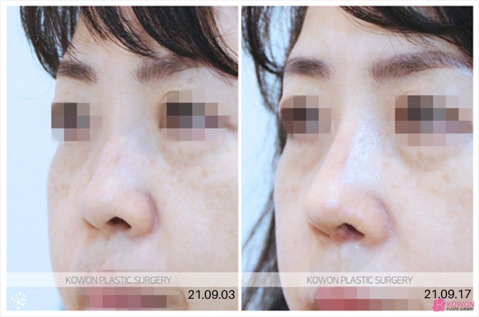 การผ่าตัดจมูกสำหรับคนอายุ 40 ปีขึ้นไป การฟื้นตัวช้าหรือไม่? — เหตุใดจึงอธิบายกระดูกอ่อนซี่โครงของตนเองและเนื้อเยื่อของตนเอง อิมแพลนต์จากร่างกายตนเองไปพร้อมกัน ภาพที่เกี่ยวข้อง 8/8